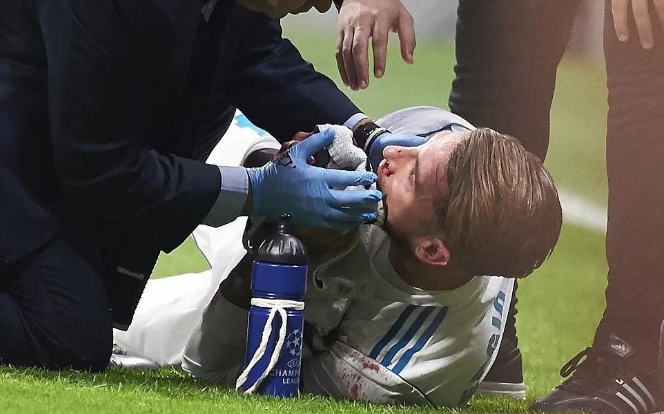 Cận cảnh Sergio Ramos bị đá vỡ mũi, máu tuôn đầm đìa - Bóng Đá