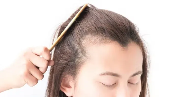 Rụng tóc lâu ngày có thể dẫn đến hói đầu.