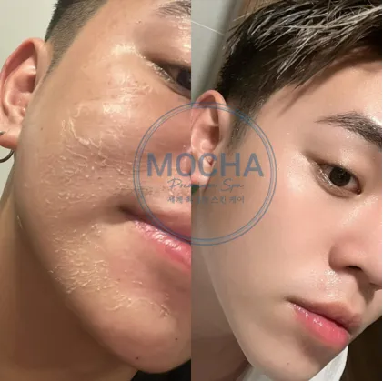 Sự thay đổi của làn da sau khi sử dụng Retinol mix Peel của Mocha