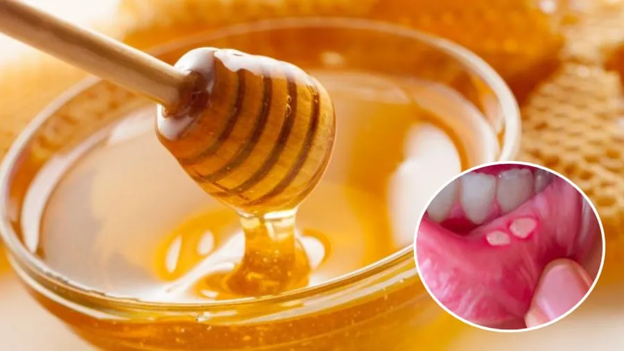 Mật ong có thể giúp vết nhiệt miệng nhanh khỏi.