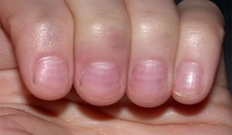 Một số dấu hiệu ít được chú ý trên ngón tay có thể là chỉ báo của 3 căn bệnh nguy hiểm