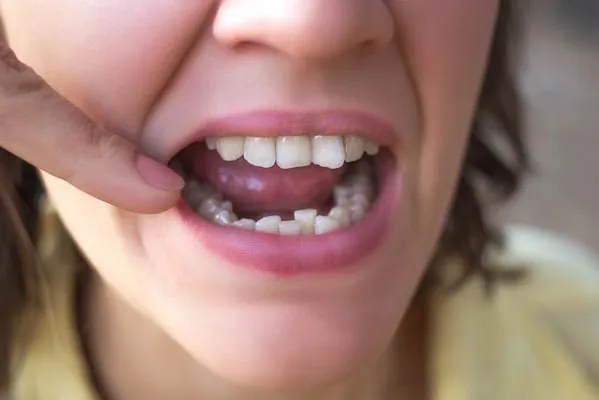  Trong văn hóa Nhật Bản, một hàm răng hoàn hảo không phải là một hàm răng trắng và đều tăm tắp.
