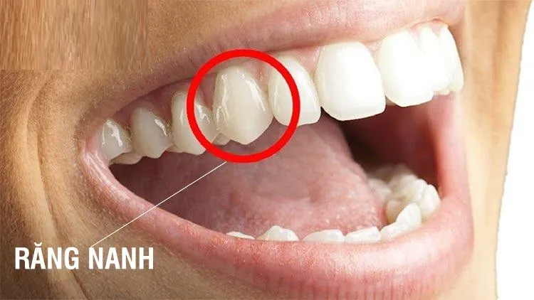 90% người Nhật đều có hàm răng không đều
