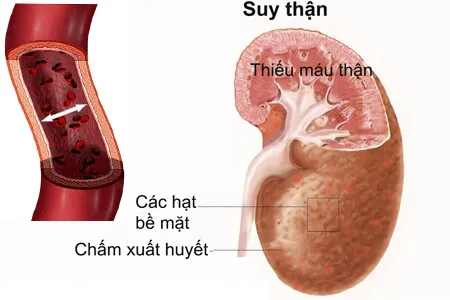 Những biểu hiện khi đi tiểu chứng tỏ bạn đã mắc bệnh thận