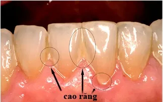 Dùng hỗn hợp này cao răng sẽ biến mất hoàn toàn sau 2 phút