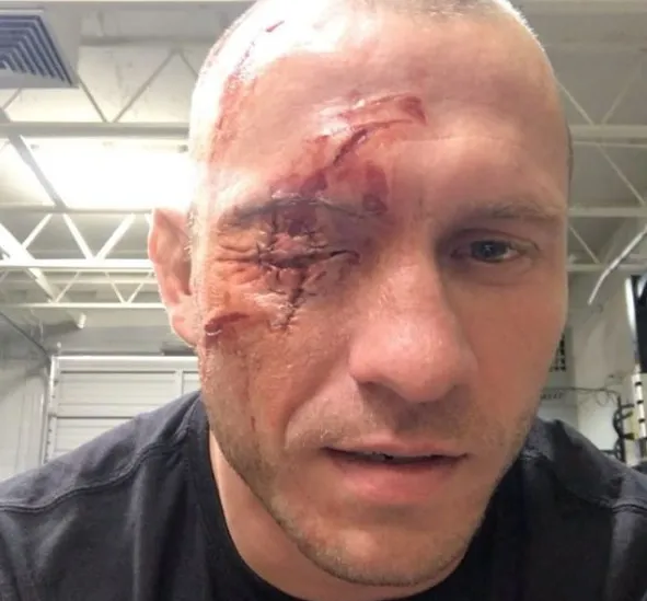 Káº¿t quáº£ hÃ¬nh áº£nh cho donald cerrone injury