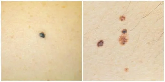 nốt ruồi, nốt ruồi trên da, cách nhận biết ung thư da, ung thư da, ung thư hắc tố, chăm sóc sức khỏe