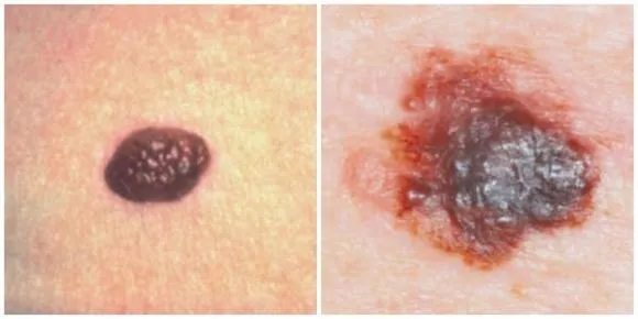 nốt ruồi, nốt ruồi trên da, cách nhận biết ung thư da, ung thư da, ung thư hắc tố, chăm sóc sức khỏe
