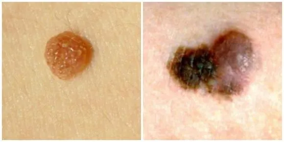 nốt ruồi, nốt ruồi trên da, cách nhận biết ung thư da, ung thư da, ung thư hắc tố, chăm sóc sức khỏe
