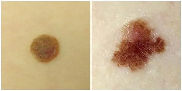 nốt ruồi, nốt ruồi trên da, cách nhận biết ung thư da, ung thư da, ung thư hắc tố, chăm sóc sức khỏe