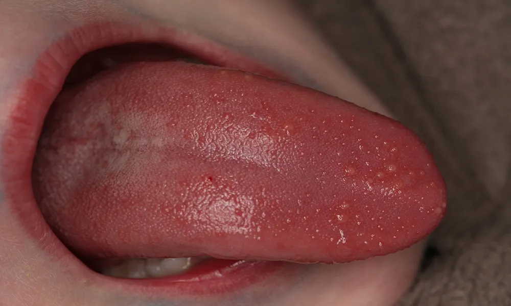 benh-nam-luoi-o-tre-va-nhung-dieu-me-can-biet-1