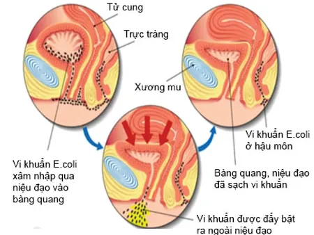 viem-duong-tiet-nieu-1