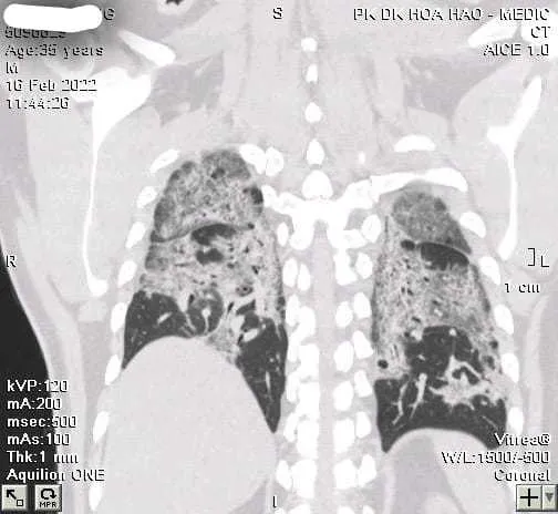 Hình ảnh phổi của bệnh nhân trắng xoá do xơ phổi tiến triển hậu Covid-19.