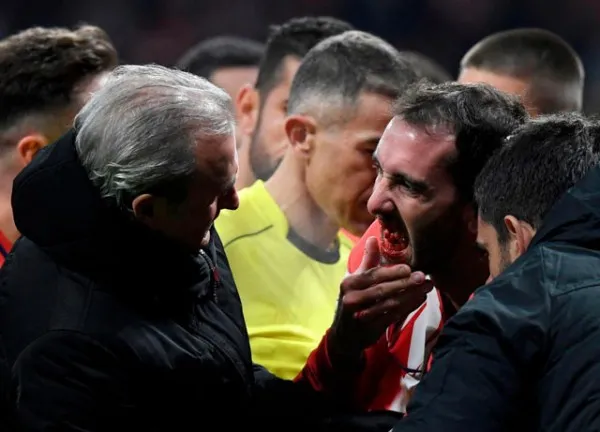 Đối phương giật cùi chỏ, sao Atletico Madrid gãy 3 răng cửa - Bóng Đá