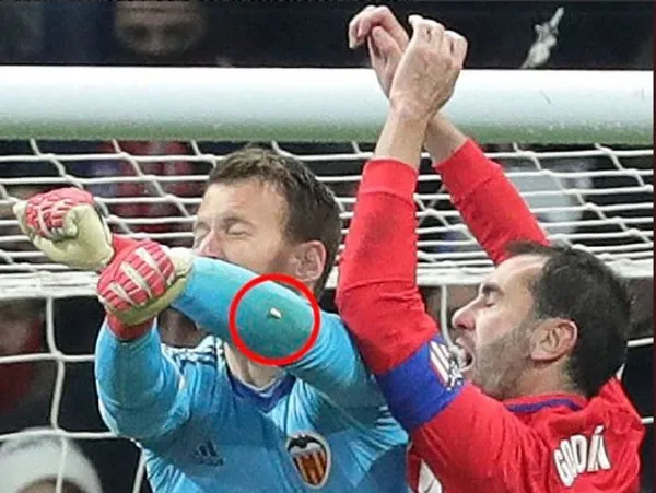 Đối phương giật cùi chỏ, sao Atletico Madrid gãy 3 răng cửa - Bóng Đá