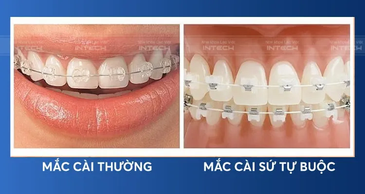 Niềng răng mắc cài thường và niềng răng mắc cài tự buộc