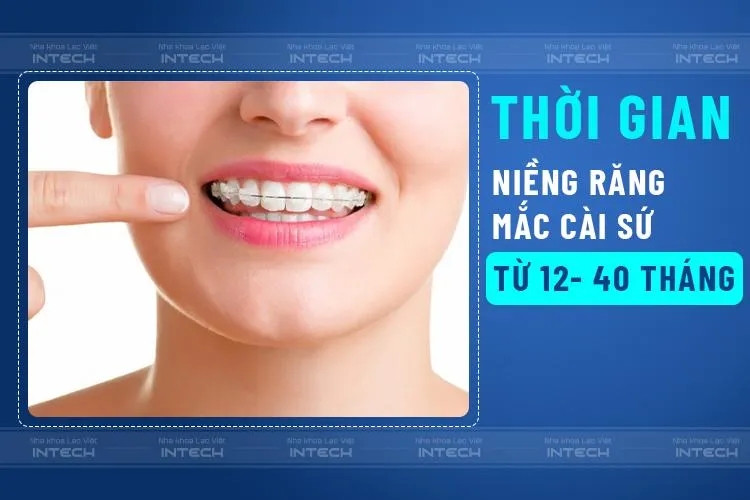 Thời gian niềng răng mắc cài sứ phụ thuộc vào nhiều yếu tố